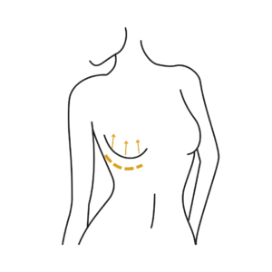 Woman's body illustration highlighting the location of the Breast lift surgery