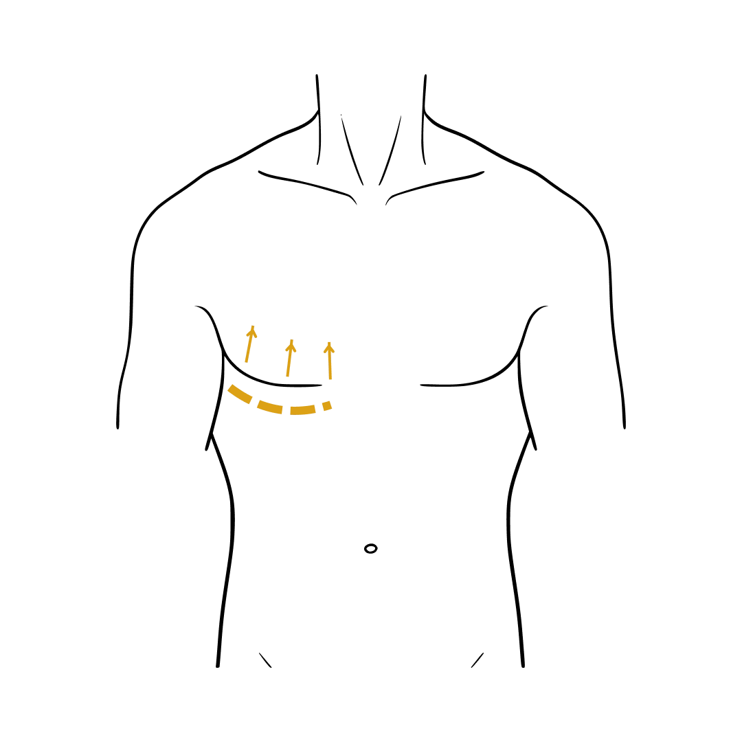 Man's body illustration highlighting the location of the Gynecomastia
