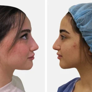 تجميل الأنف عملية تجميل الأنف تجميل الانف تجميل الخشم