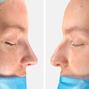 تجميل الأنف عملية تجميل الأنف تجميل الانف تجميل الخشم