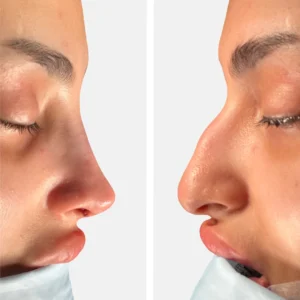 تجميل الأنف عملية تجميل الأنف تجميل الانف تجميل الخشم